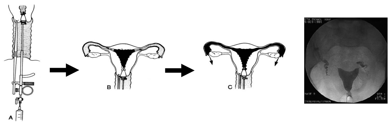輸卵管攝影檢查